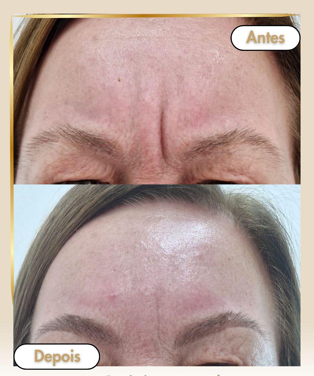 Botox Caso 1