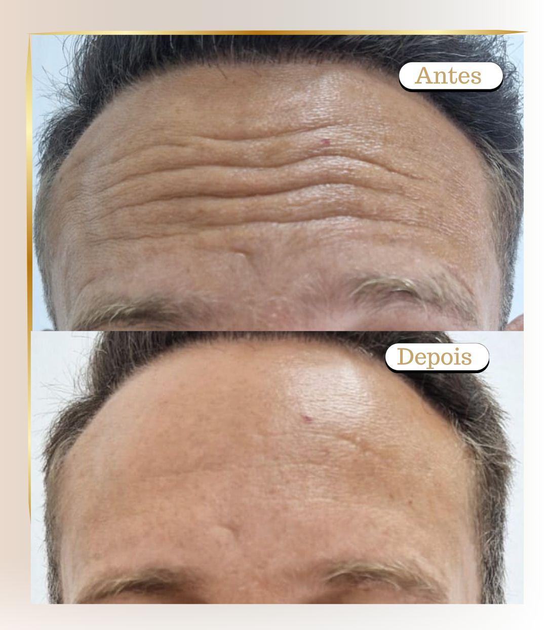 Botox Caso 2